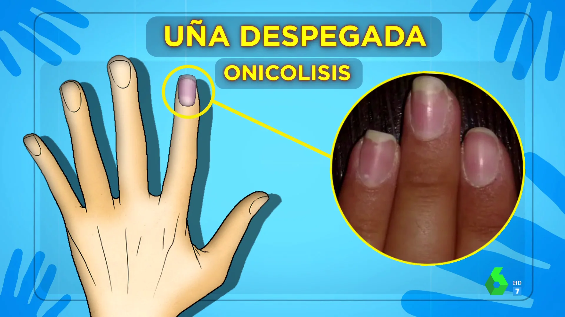 ¿Por qué se rompen mucho las uñas? Boticaria García explica las causas que están detrás y qué hacer cuando ocurre