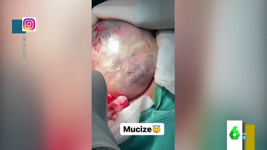 Bebé en el saco amniótico Bebé en el saco amniótico