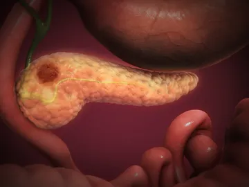 cáncer de páncreas cáncer de páncreas