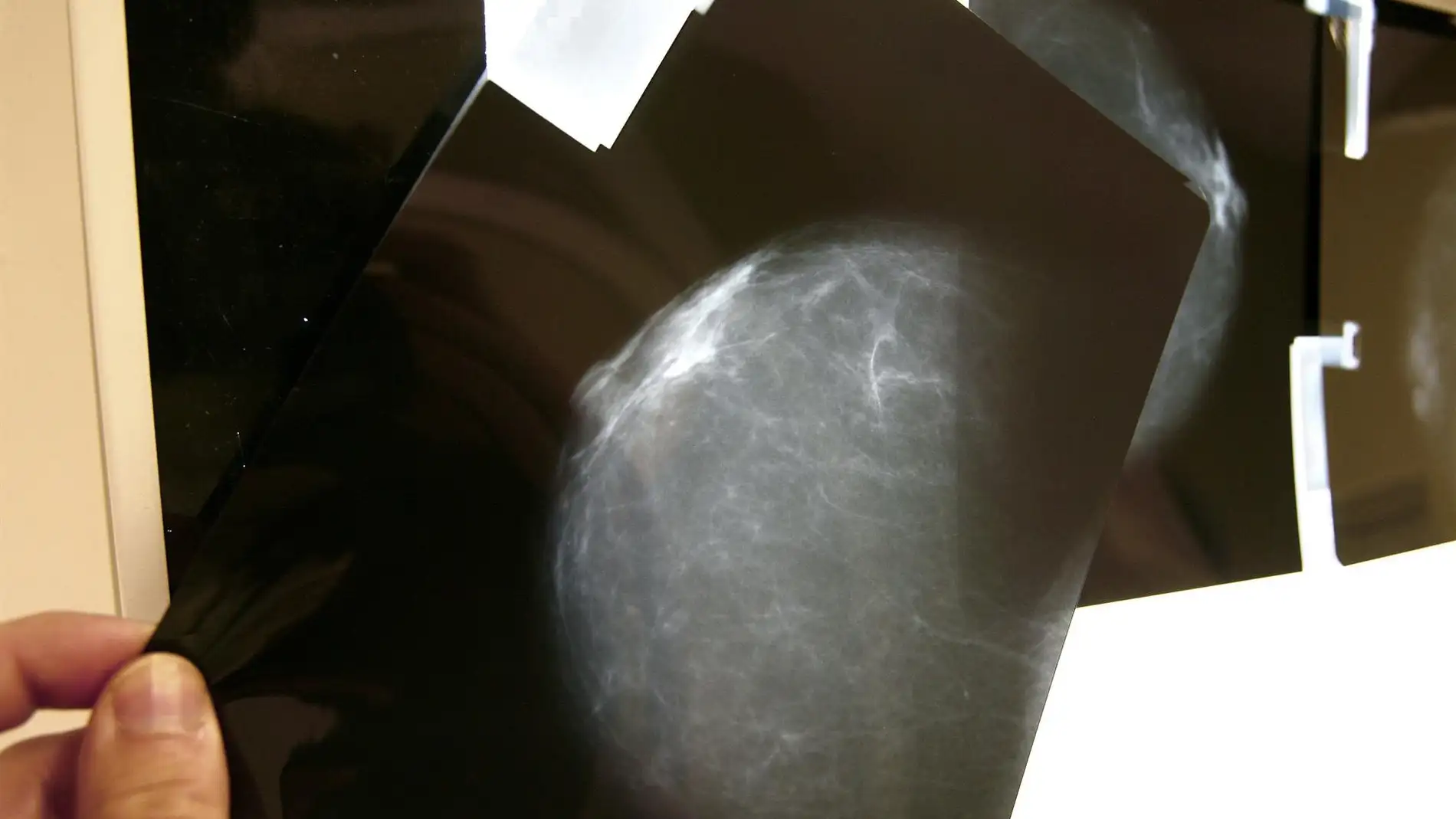 Radiografía mamaria