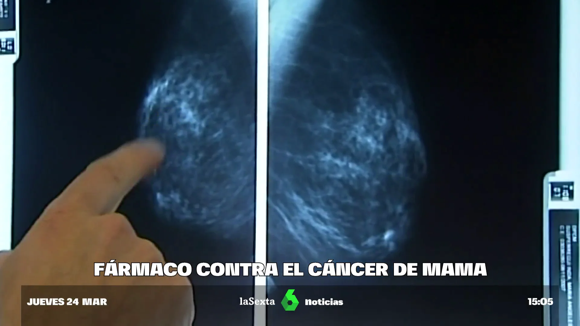 Nuevo fármaco contra el cáncer de mama