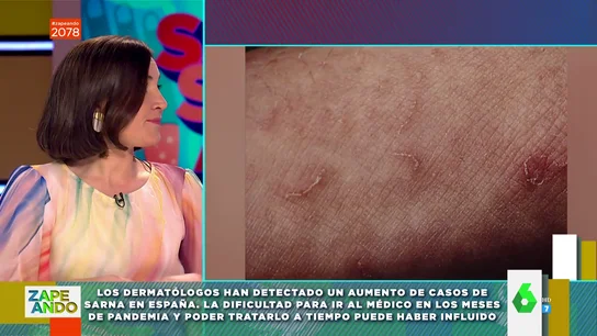 Qué es la sarna y por qué se produce: Boticaria García explica el motivo del aumento de casos en España Qué es la sarna y por qué se produce: Boticaria García explica el motivo del aumento de casos en España