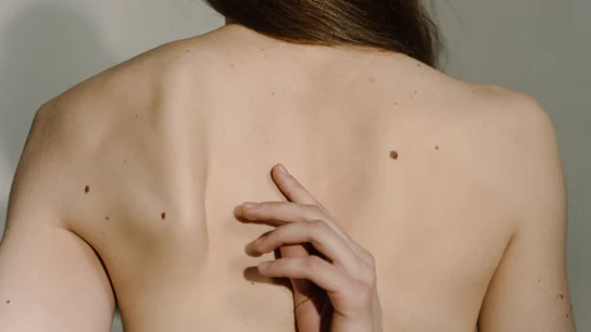 Es importante revisarse los lunares de la piel para prevenir el melanoma Es importante revisarse los lunares de la piel para prevenir el melanoma