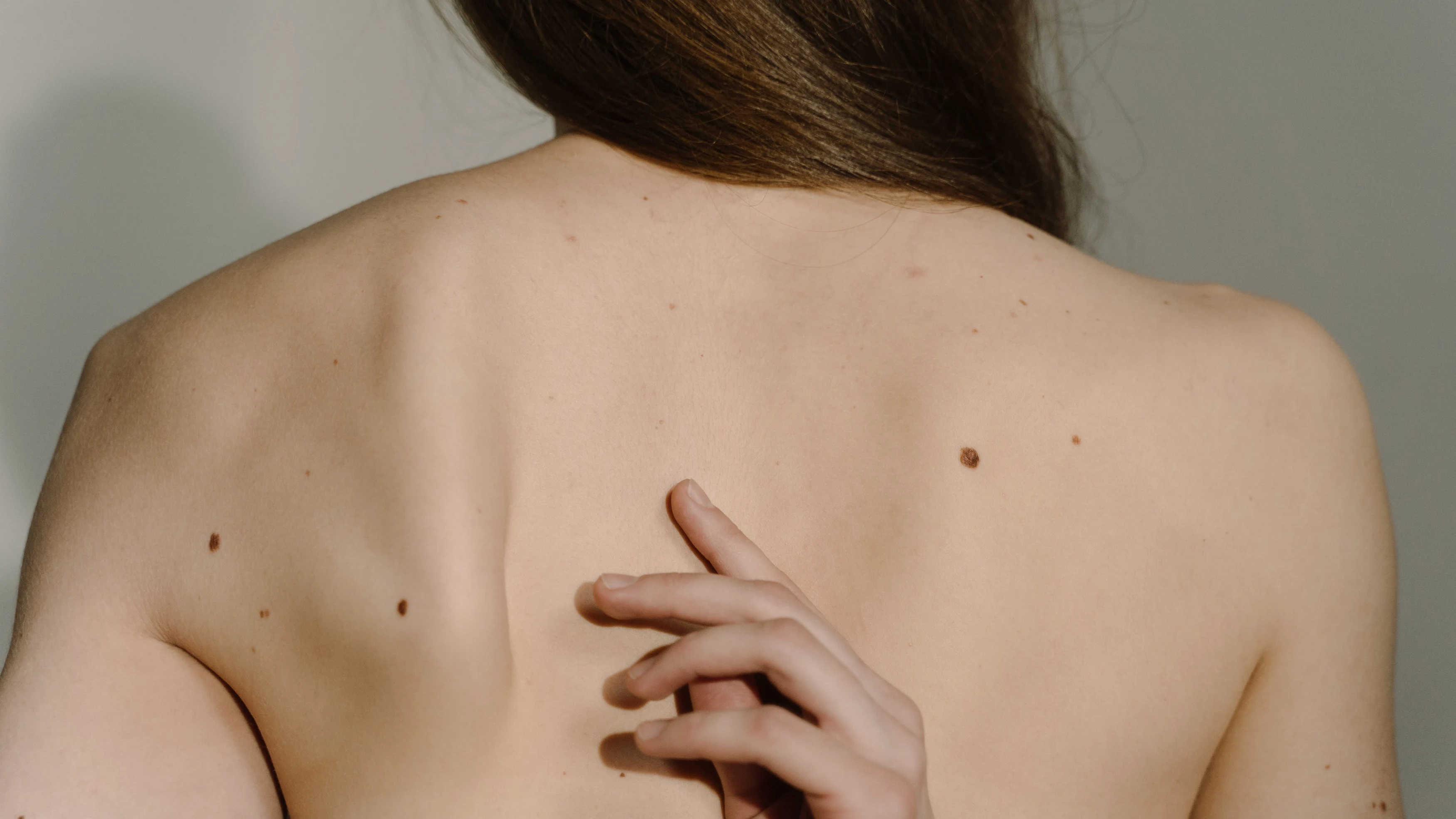 Es importante revisarse los lunares de la piel para prevenir el melanoma