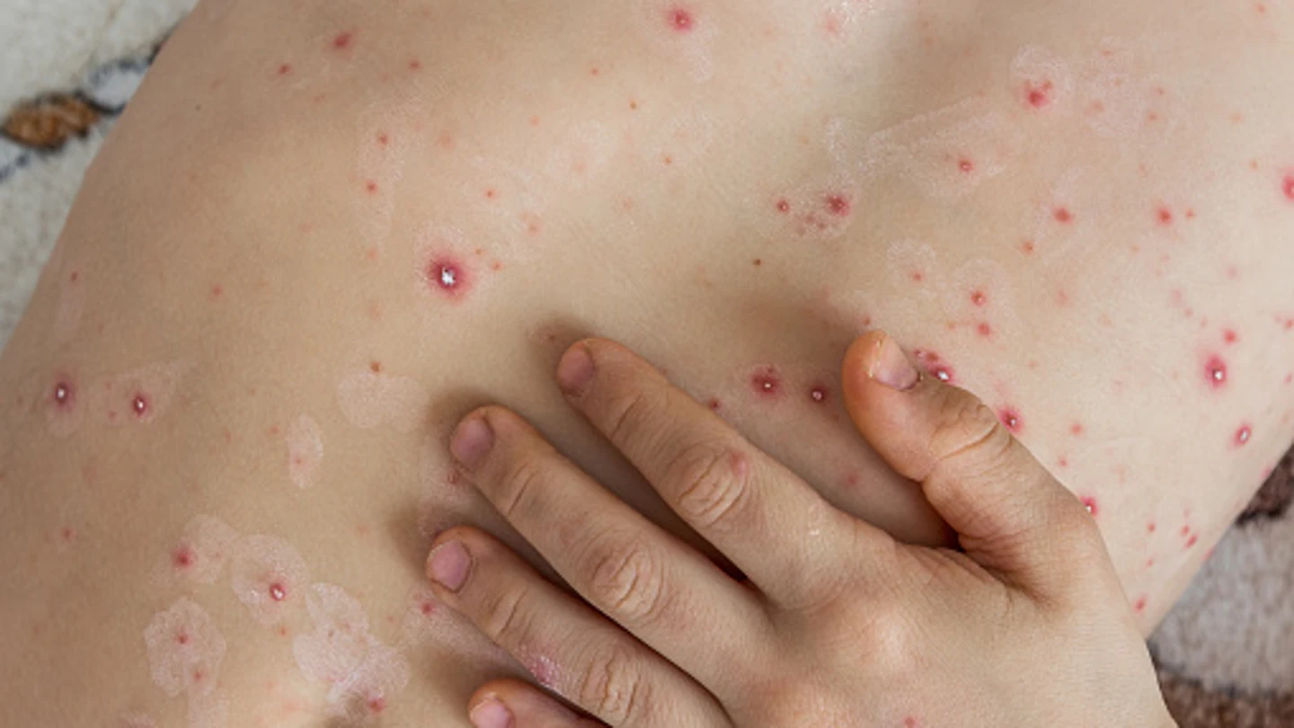 Qué es el herpes zóster o la culebrilla Qué es el herpes zóster o la culebrilla