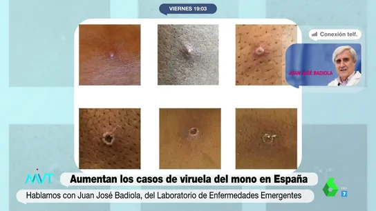 El doctor Badiola identifica los grupos de riesgo ante la viruela del mono y tranquiliza: "No va a ser una pandemia" El doctor Badiola identifica los grupos de riesgo ante la viruela del mono y tranquiliza: "No va a ser una pandemia"