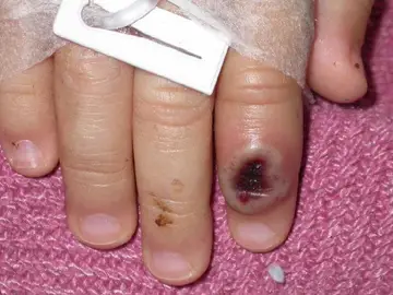 El dedo de un niño infectado por la llamada viruela de mono (monkeypox)