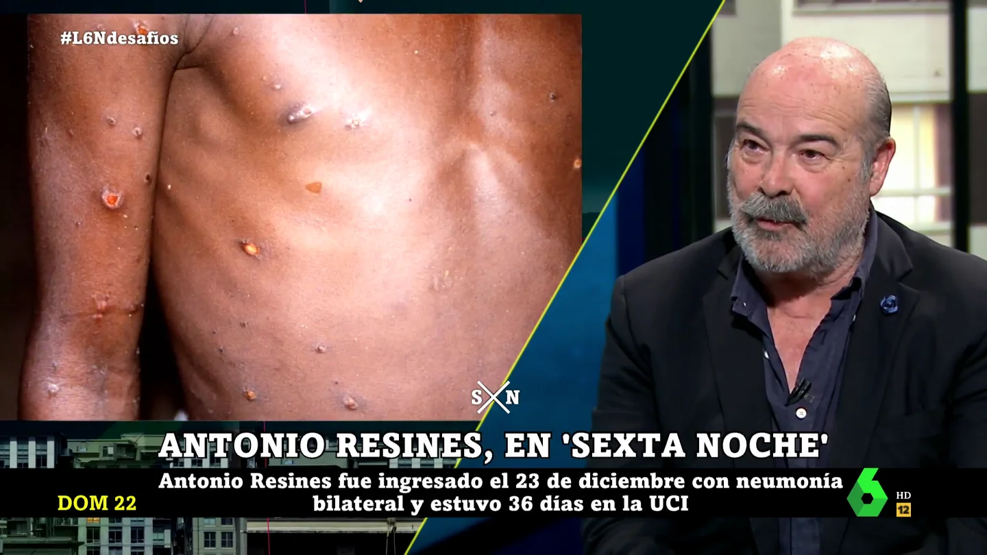 La sincera opinión de Antonio Resines sobre la expansión de la viruela del mono La sincera opinión de Antonio Resines sobre la expansión de la viruela del mono