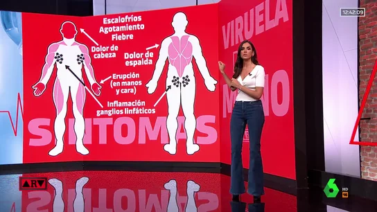 Las claves de la viruela del mono: qué es, síntomas y cómo se contagia Viruela del mono