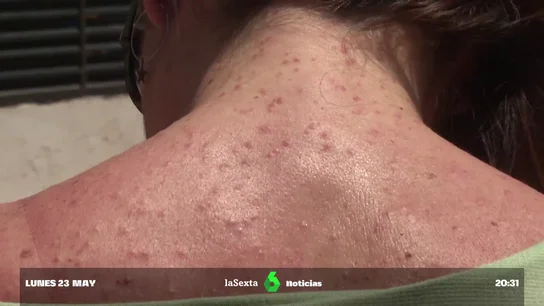 "Conforme pasaba la noche me iba picando todo": denuncian una plaga de pulgas en un festival que confundieron con viruela del mono "Conforme pasaba la noche me iba picando todo": denuncian una plaga de pulgas en un festival que confundieron con viruela del mono