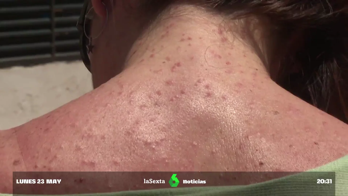 "Conforme pasaba la noche me iba picando todo": denuncian una plaga de pulgas en un festival que confundieron con viruela del mono "Conforme pasaba la noche me iba picando todo": denuncian una plaga de pulgas en un festival que confundieron con viruela del mono