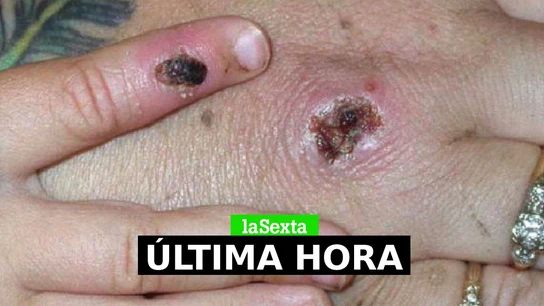 Viruela del mono en directo: última hora de los casos confirmados y contagios en España Viruela del mono en directo: última hora de los casos confirmados y contagios en España