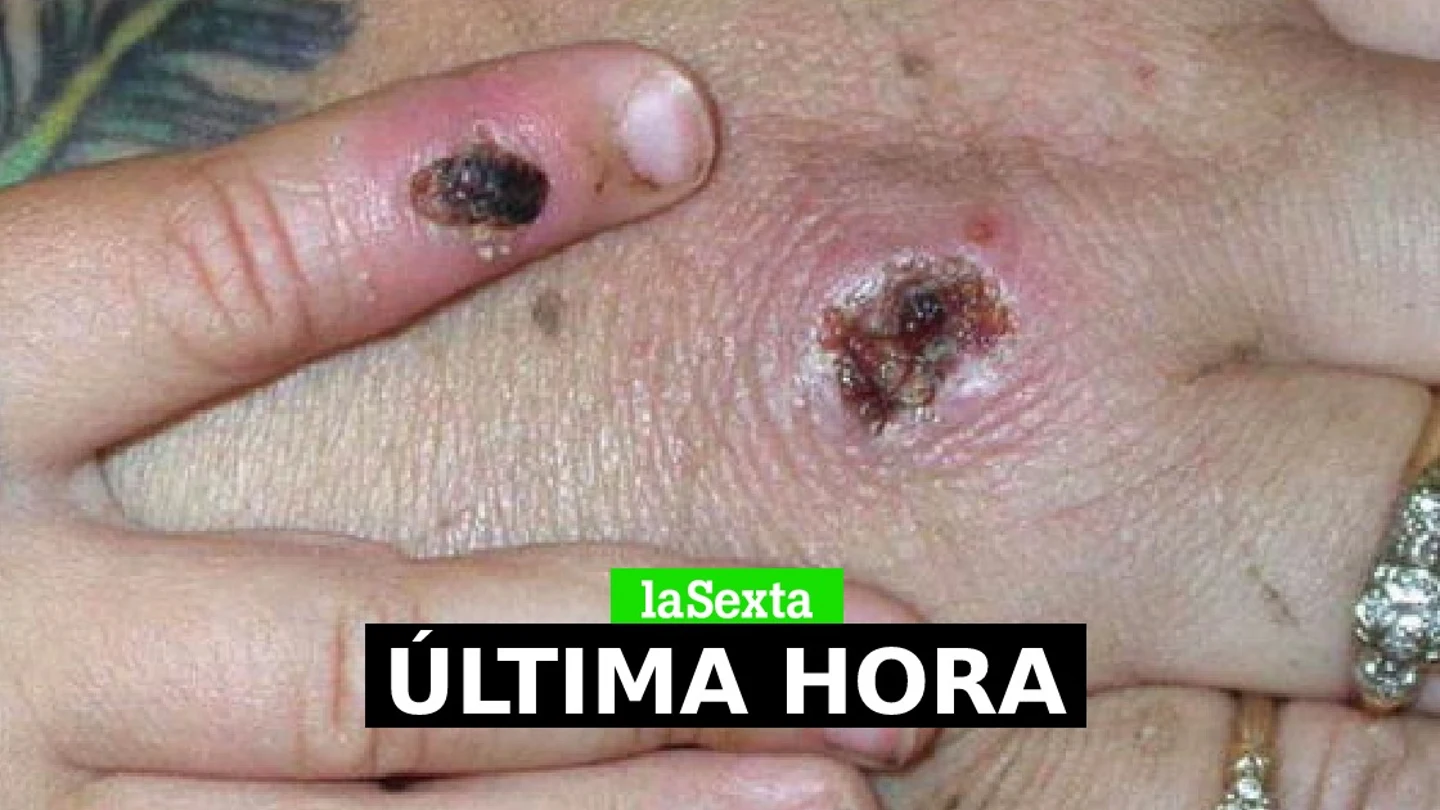 Viruela del mono en directo: última hora de los casos confirmados y contagios en España Viruela del mono en directo: última hora de los casos confirmados y contagios en España
