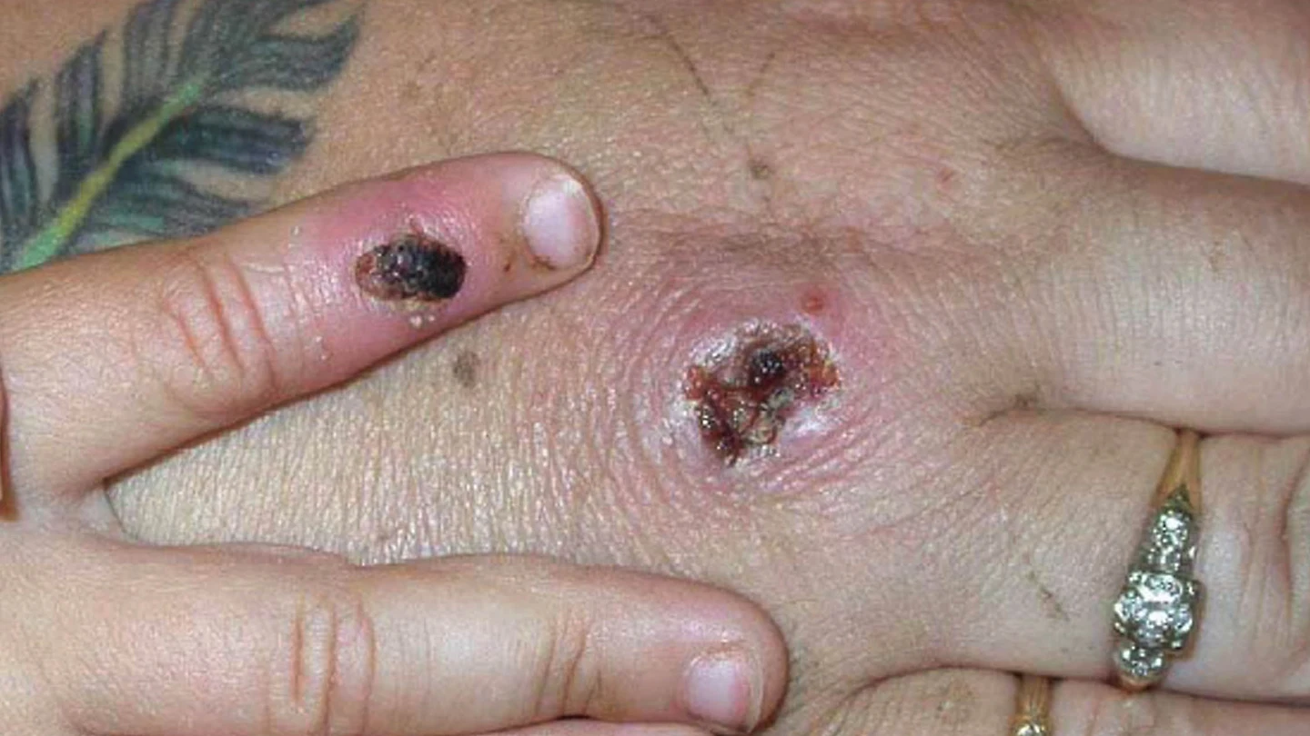 Heridas provocadas por la viruela del mono Heridas provocadas por la viruela del mono