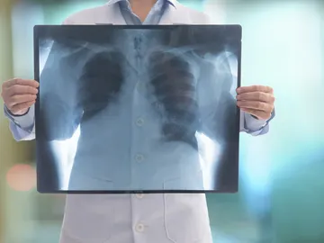 Radiografía de un pulmón Radiografía de un pulmón