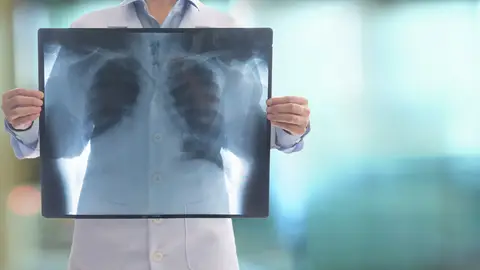 Radiografía de un pulmón Radiografía de un pulmón