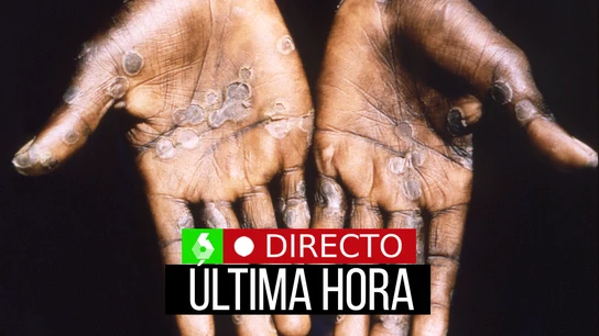 La última hora de la viruela del mono en España, en directo La última hora de la viruela del mono en España, en directo