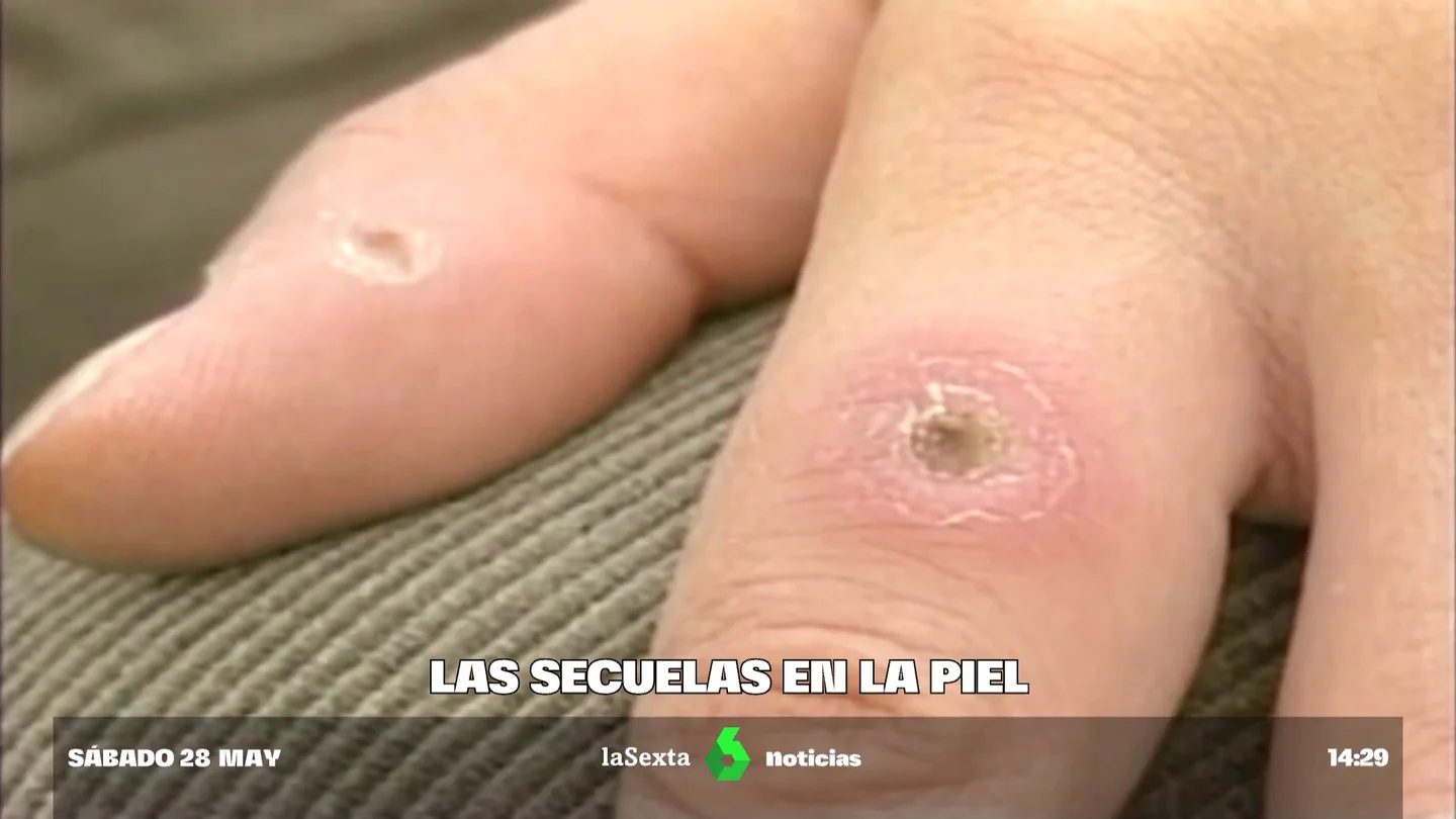 Cuáles son las secuelas de la viruela del mono Cuáles son las secuelas de la viruela del mono