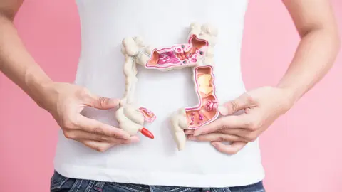 Cáncer colorrectal Cáncer colorrectal