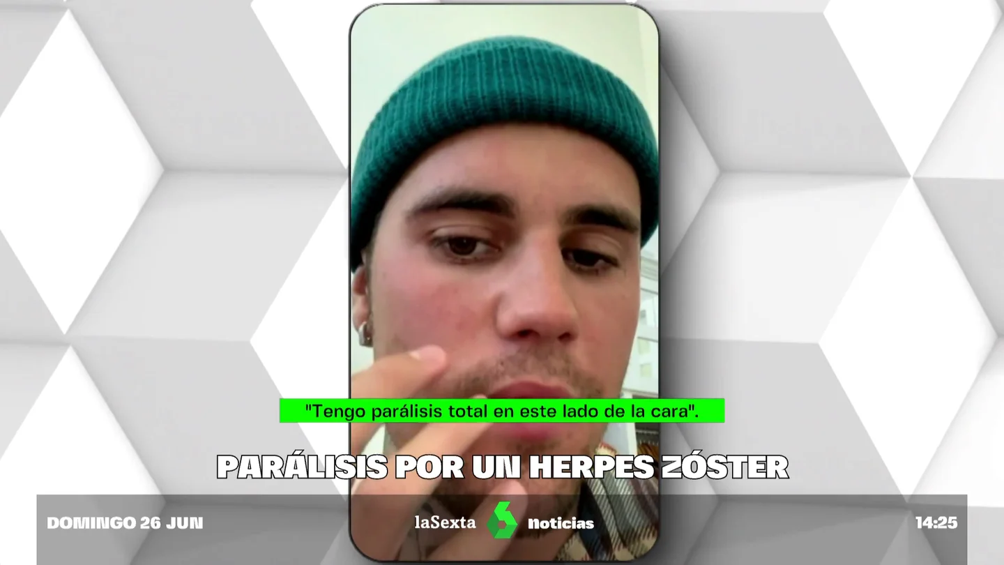 HERPES ZOSTER HERPES ZOSTER