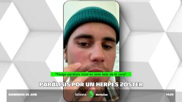 HERPES ZOSTER