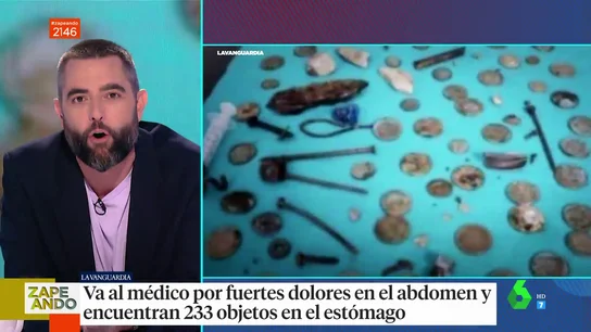Le encuentran más de 200 objetos en el estomago Le encuentran más de 200 objetos en el estomago