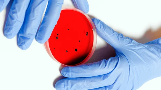 Qué es el virus de Marburgo, una enfermedad de la familia del ébola para la que la OMS ha emitido alerta  Qué es el virus de Marburgo, una enfermedad de la familia del ébola para la que la OMS ha emitido alerta