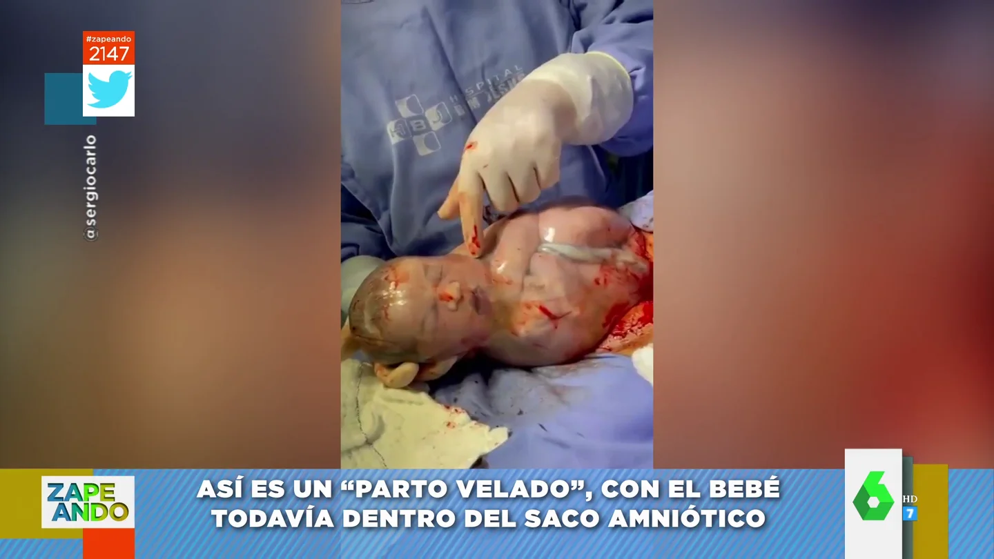El espectacular vídeo de un 'parto velado': explotan el saco amniótico de un bebé recién nacido El espectacular vídeo de un 'parto velado': explotan el saco amniótico de un bebé recién nacido