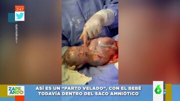 El espectacular vídeo de un 'parto velado': explotan el saco amniótico de un bebé recién nacido