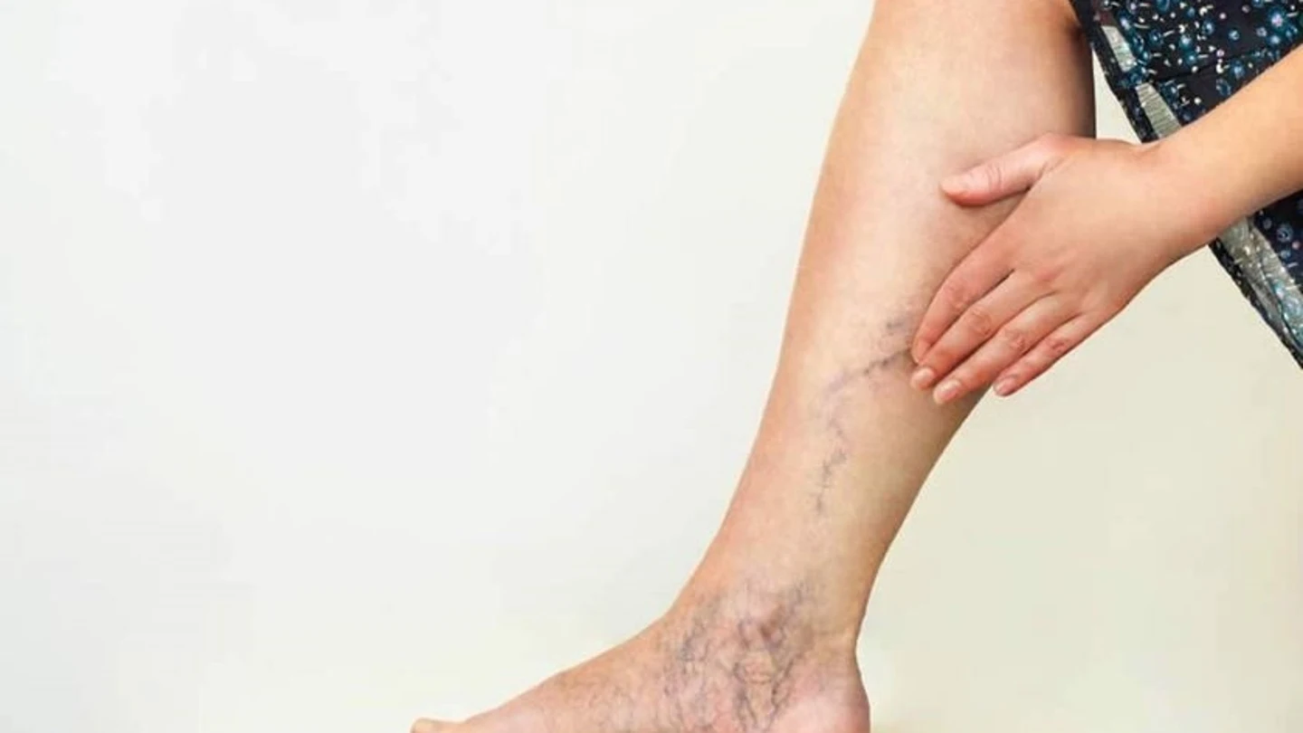 Por qué salen varices en las piernas: ¿sirven las cremas para eliminarlas? Por qué salen varices en las piernas: ¿sirven las cremas para eliminarlas?