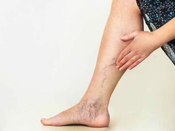 Por qué salen varices en las piernas: ¿sirven las cremas para eliminarlas?  