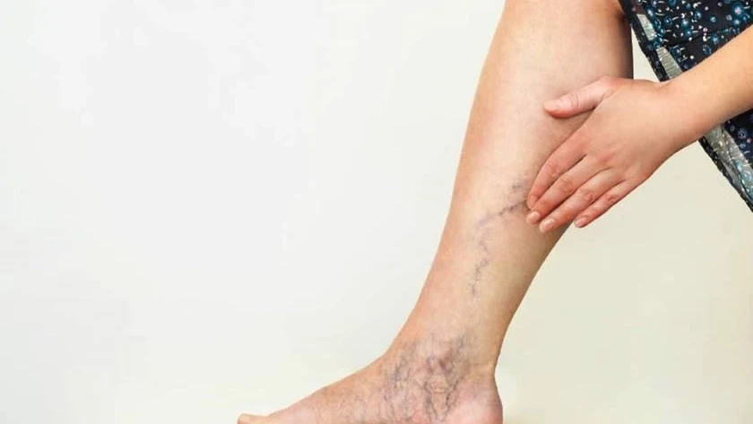 Por qué salen varices en las piernas: ¿sirven las cremas para eliminarlas? 