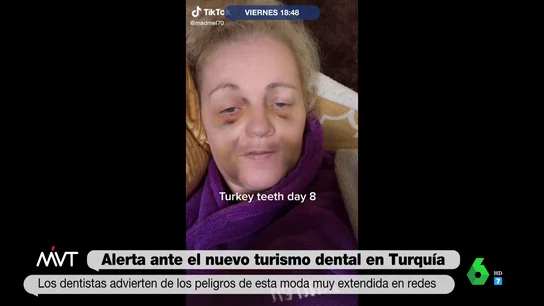 Desastroso resultado de tratamiento dental en Turquía Desastroso resultado de tratamiento dental en Turquía