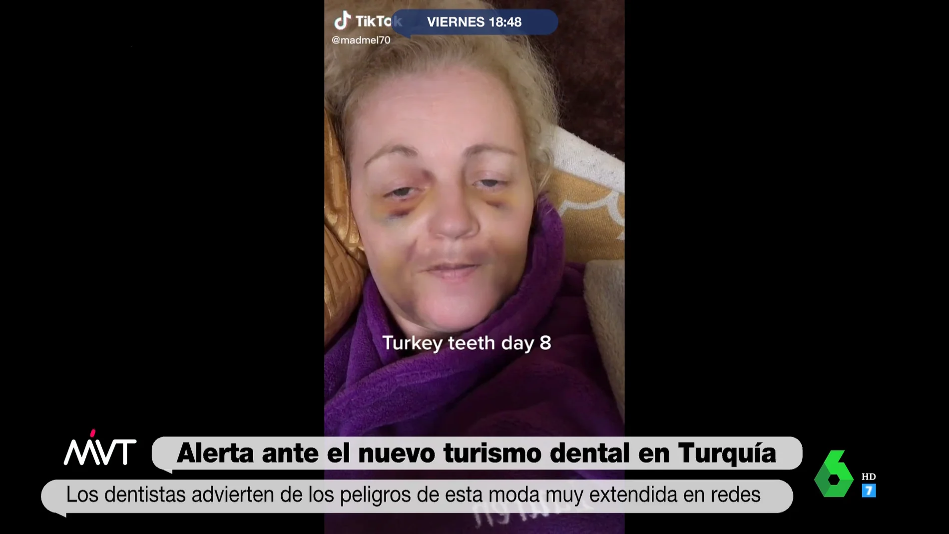 Desastroso resultado de tratamiento dental en Turquía
