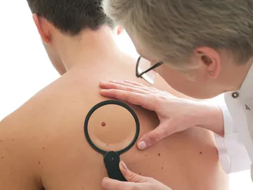 Cáncer de piel Cáncer de piel