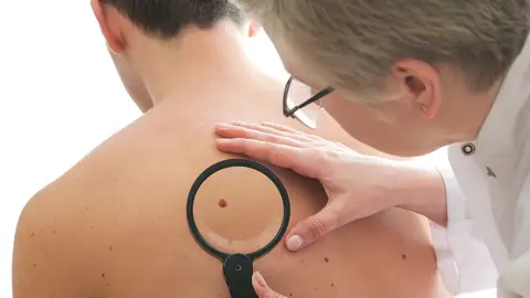 Cáncer de piel Cáncer de piel