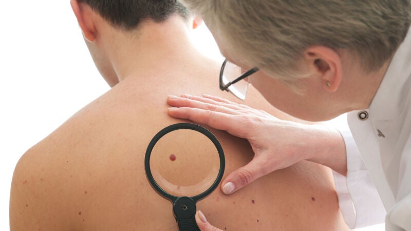 Un gel podría combatir el cáncer de piel en una sola sesión