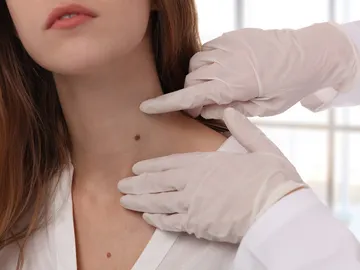 Cáncer de piel Cáncer de piel