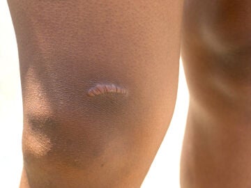Cicatriz hipertrófica o queloide