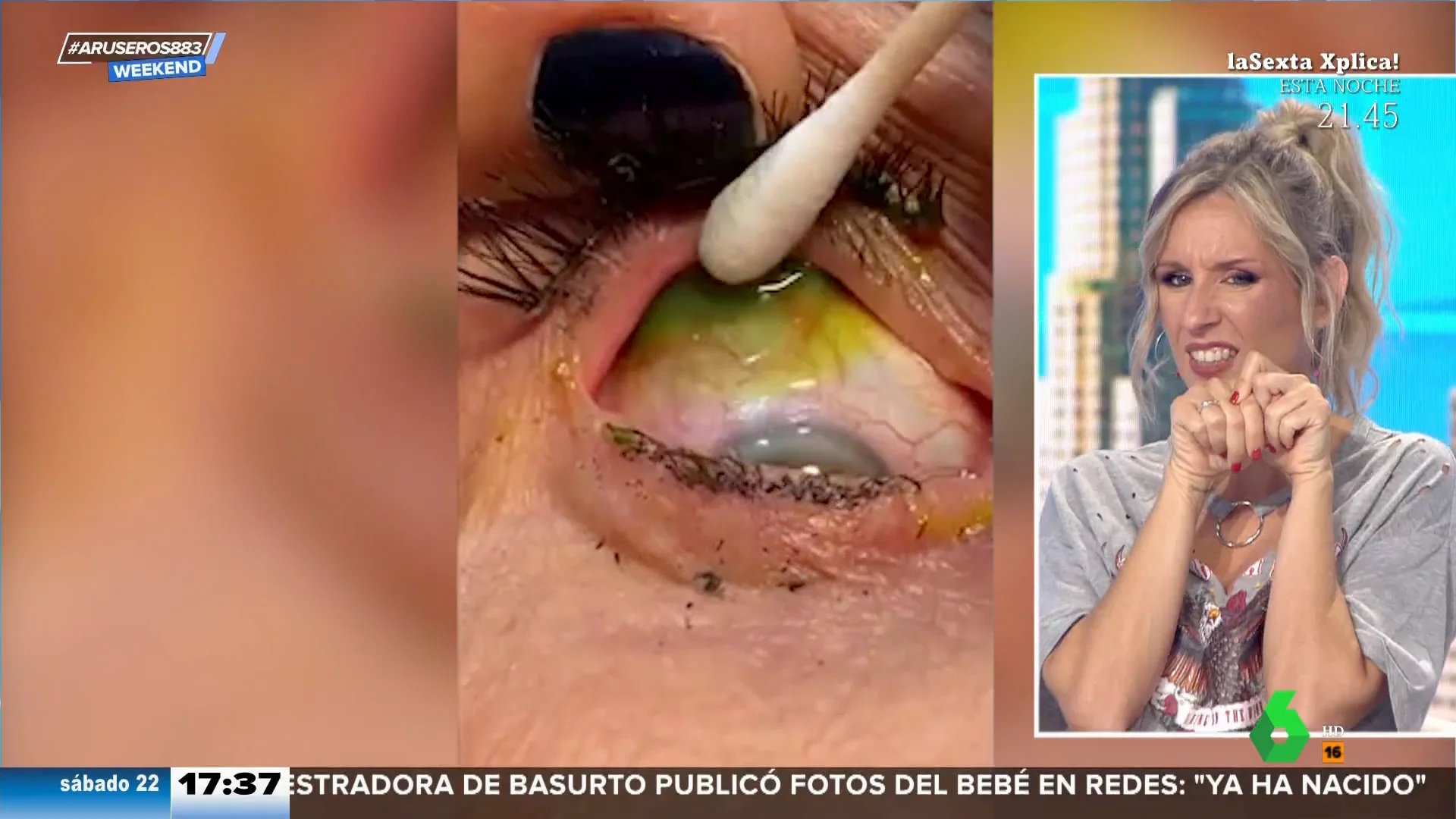 Una mujer tenía 23 lentillas olvidadas dentro de su ojo derecho