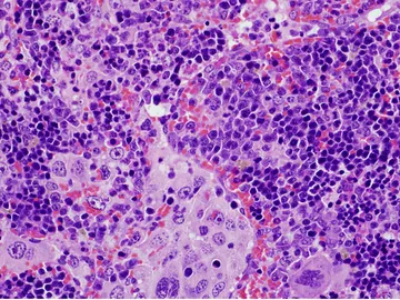 Hallada una mutacion genetica clave en la aparicion de linfomas y en el cancer de pulmon Hallada una mutacion genetica clave en la aparicion de linfomas y en el cancer de pulmon