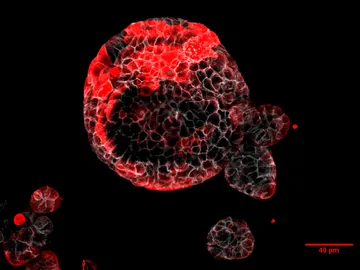 Organoide de cáncer colorrectal con células residuales responsables de la recaída Organoide de cáncer colorrectal con células residuales responsables de la recaída
