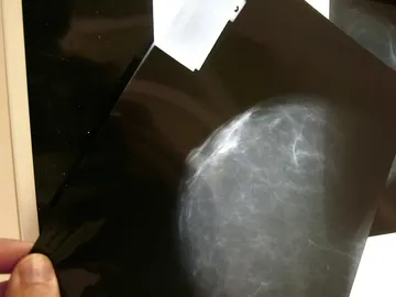 Cáncer de mama Cáncer de mama