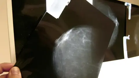 Cáncer de mama Cáncer de mama