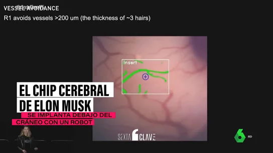 El chip cerebral de Elon Musk: las pruebas en el primer humano comenzarán en seis meses El chip cerebral de Elon Musk: las pruebas en el primer humano comenzarán en seis meses