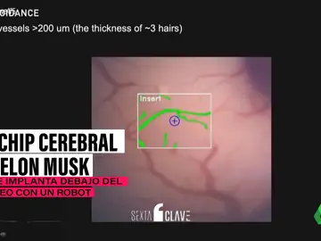 El chip cerebral de Elon Musk: las pruebas en el primer humano comenzarán en seis meses