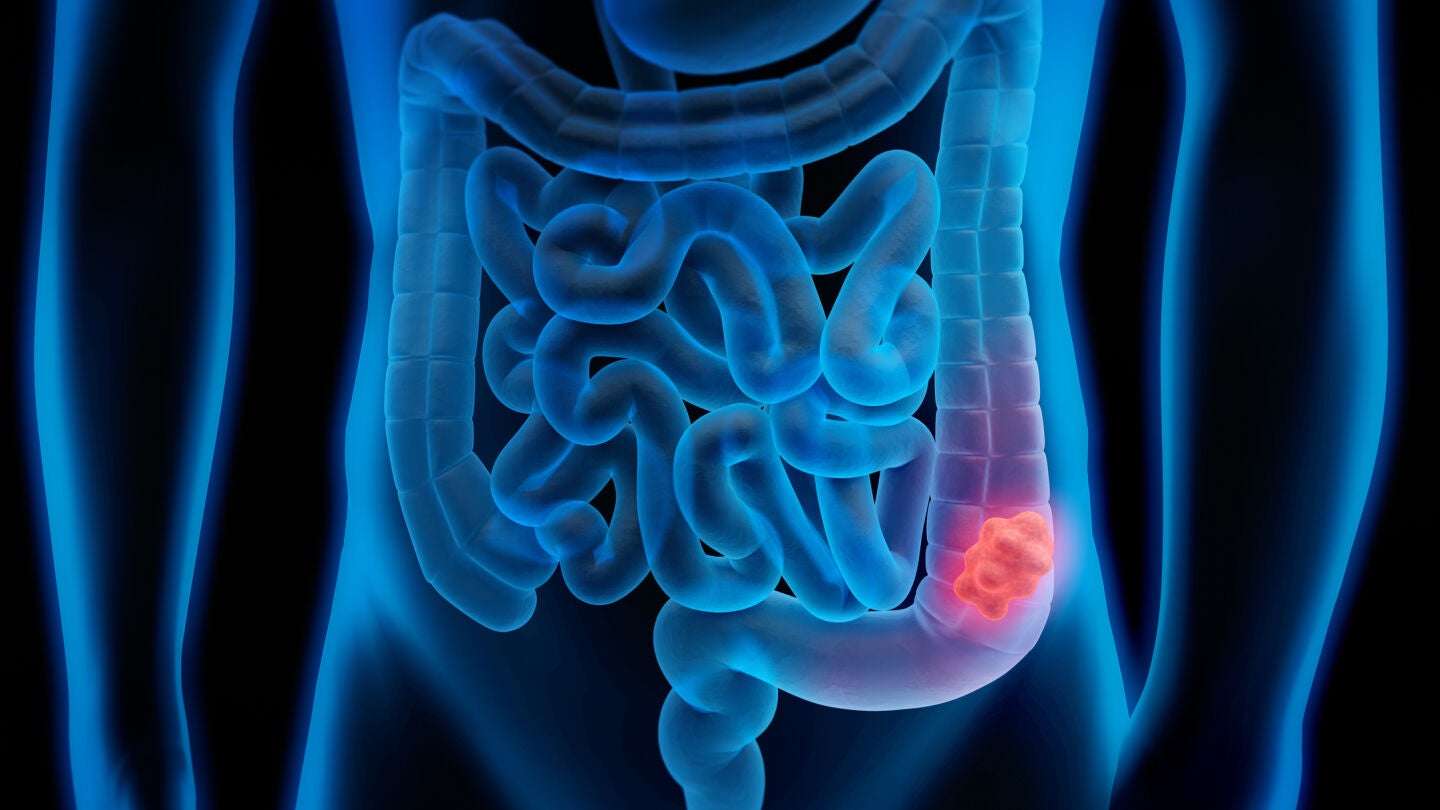 C&aacute;ncer colorrectal