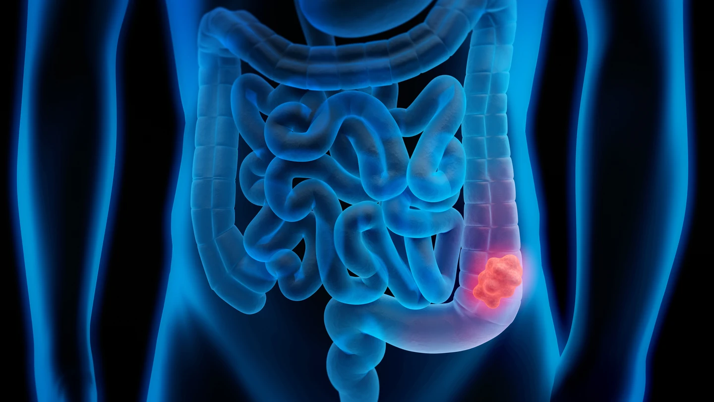 Cáncer colorrectal Cáncer colorrectal