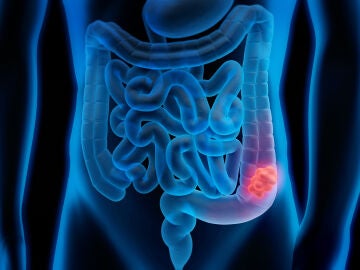 C&aacute;ncer colorrectal