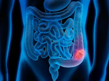 Cáncer colorrectal Cáncer colorrectal